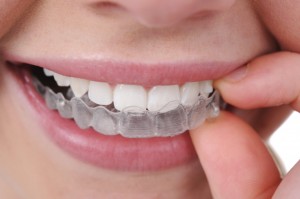 invisalign1